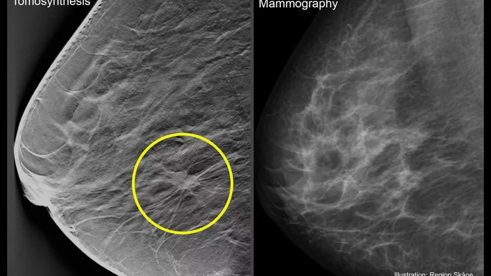 Tomosynthis. Mammography. Photo.