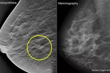 Tomosynthis. Mammography. Photo.