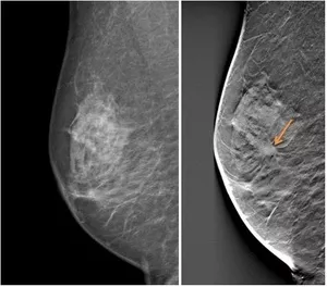 Figure 2: A 2D mammogram compared to a 3D breast tomosynthesis slice.
